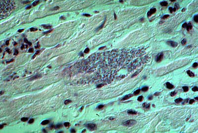 Infected section of heart muscle