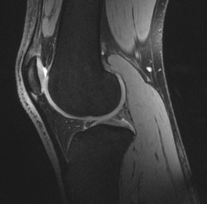 Scanning knees to reveal cartilage health in space and on Earth