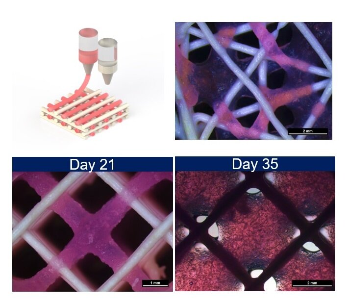 Zweistufiger 3D-Druck von Kalziumphosphatkeramik und menschlichem Plasma zur Herstellung von Knochengewebe.