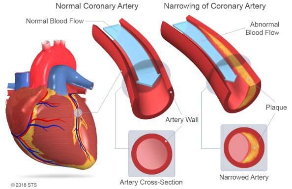 3D views of a normal artery versus a narrowed artery