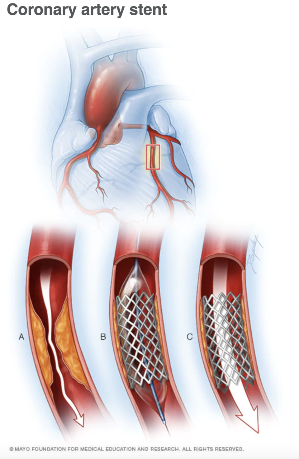 Opening stenosed arteries with stent 