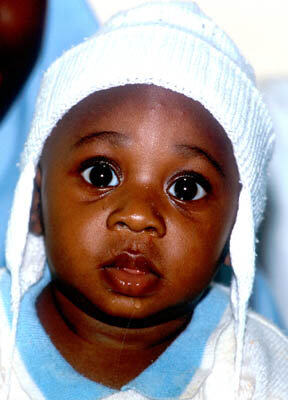 Baby suffering from malaria