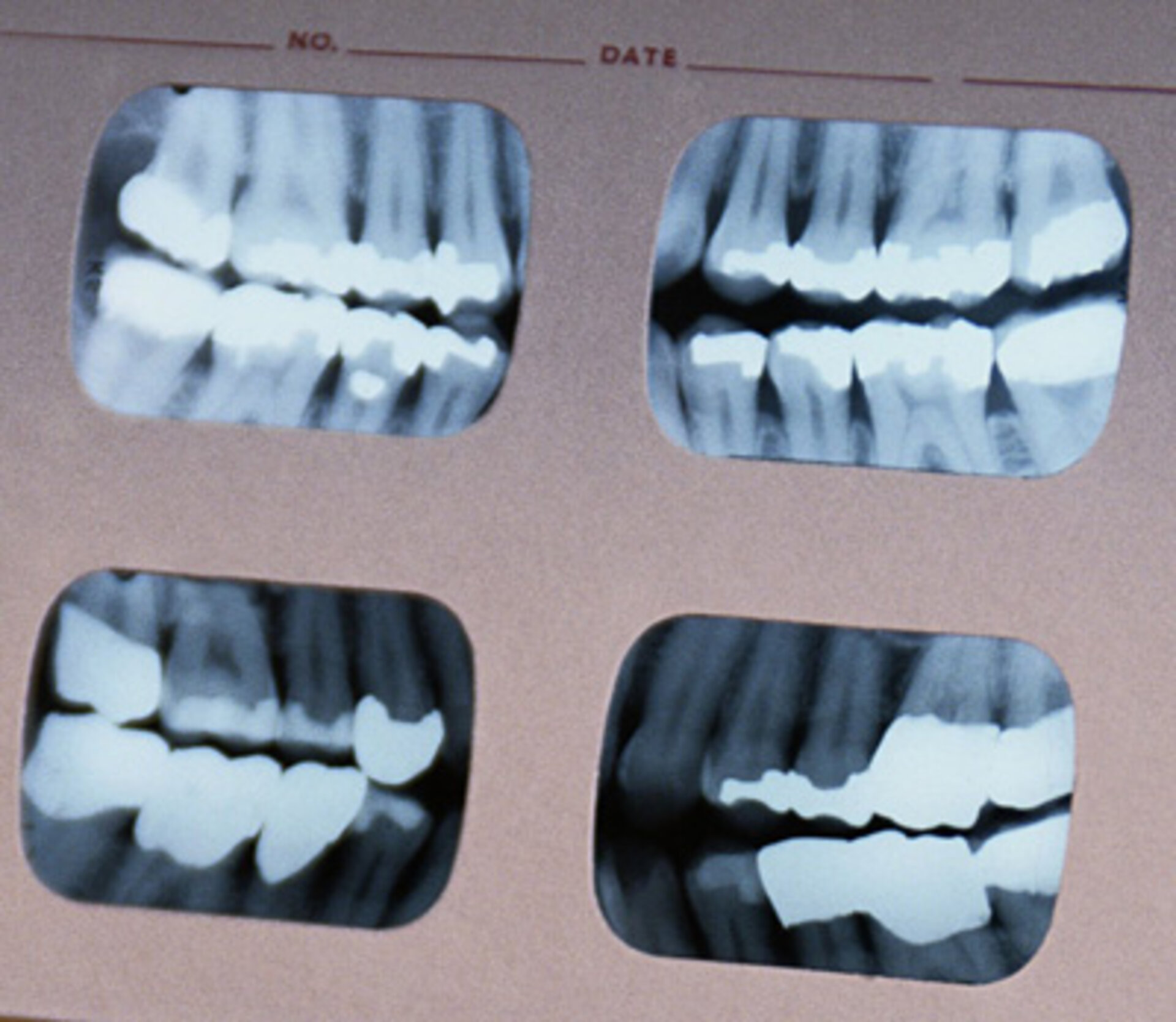 X-ray dental image