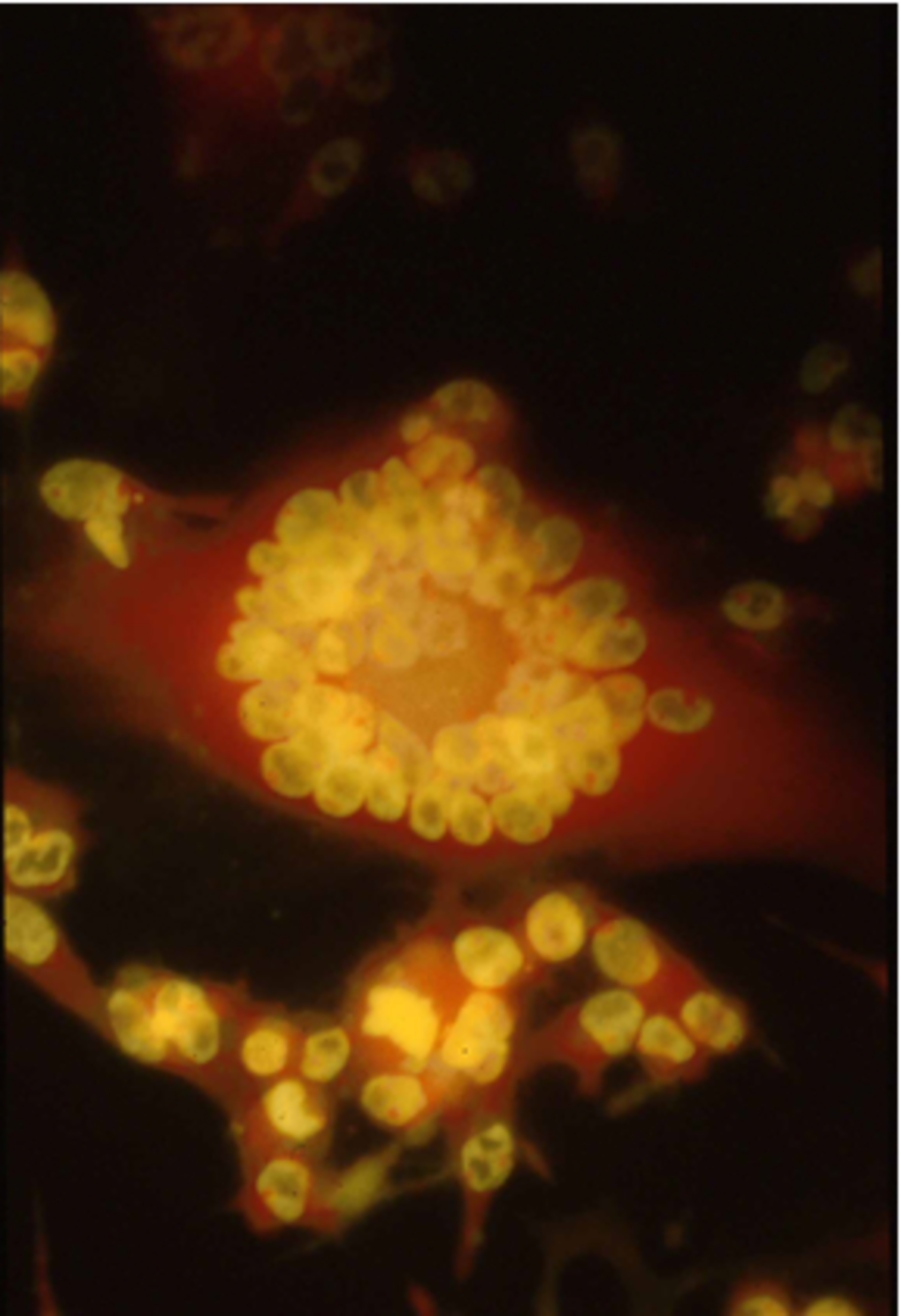 VZV-infizierte MeWo-Zellen: Zu erkennen sind die typischen, vom Herpesvirus induzierten, mehrkernigen Riesenzellen. Die Kulturen wurden zum Nachweis von RNA (rot) im Zytoplasma mit Acridinorange eingefärbt.