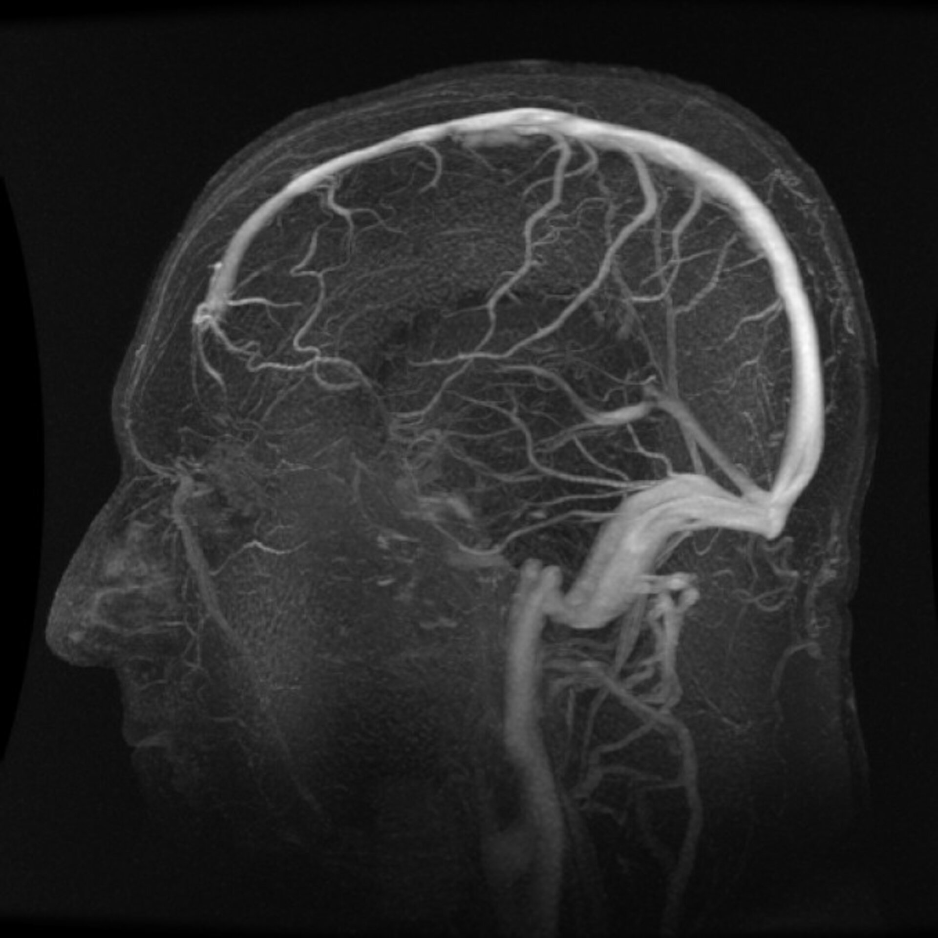 Кт сосудов головы и шеи. Магнитно-резонансная ангиография головного мозга. Магнитно-резонансная венография головного мозга. Мрт ангиограмма сосудов головного мозга. Мрт сосудов головного мозга (мрт-ангиография).