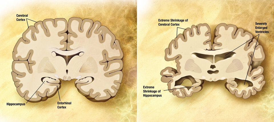 Brain with Alzheimer's disease to the right