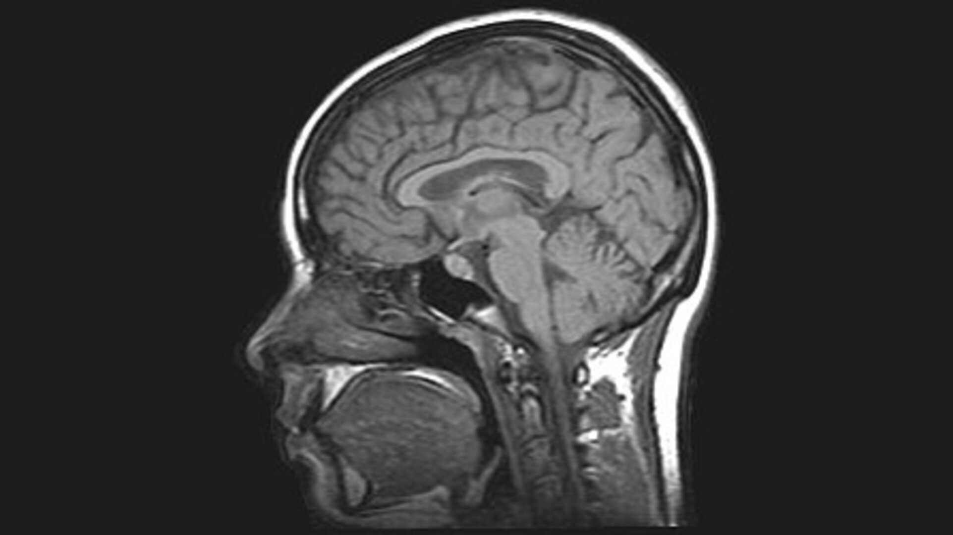 Esa Mri Brain Scan