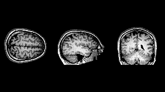 Διαδοχικές σαρώσεις εγκεφάλου MRI σε 3 επίπεδα
