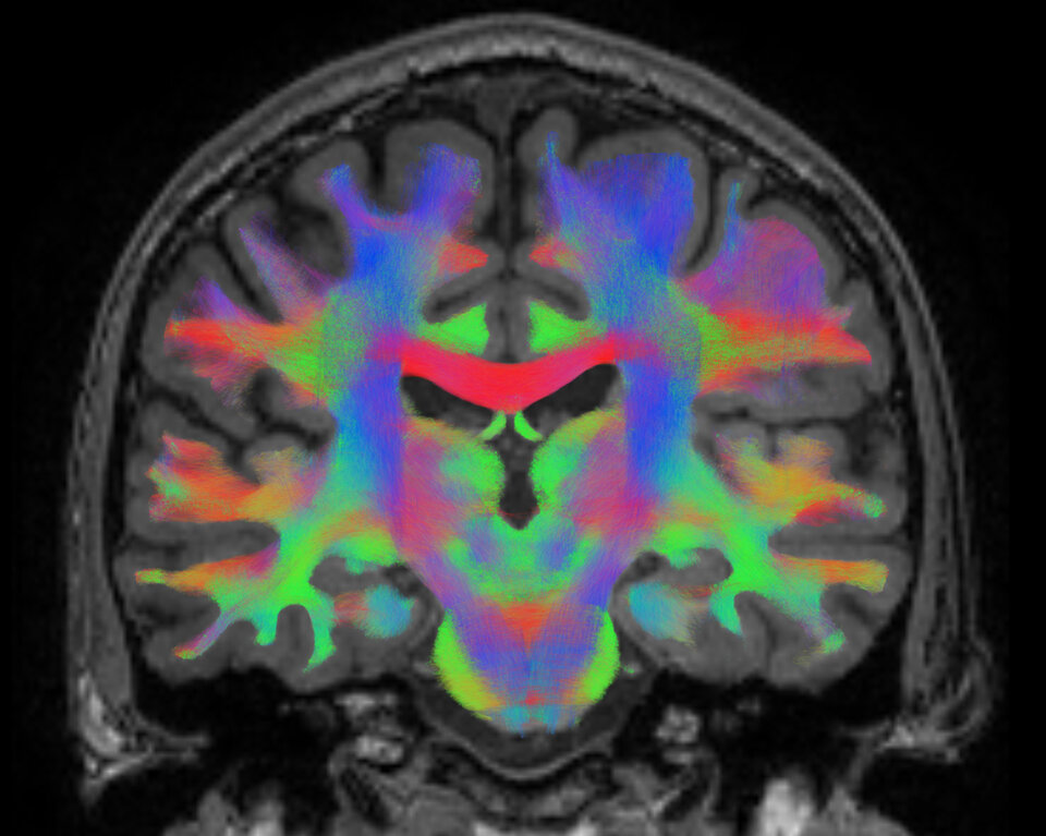 Neural networks shown in MRI scan