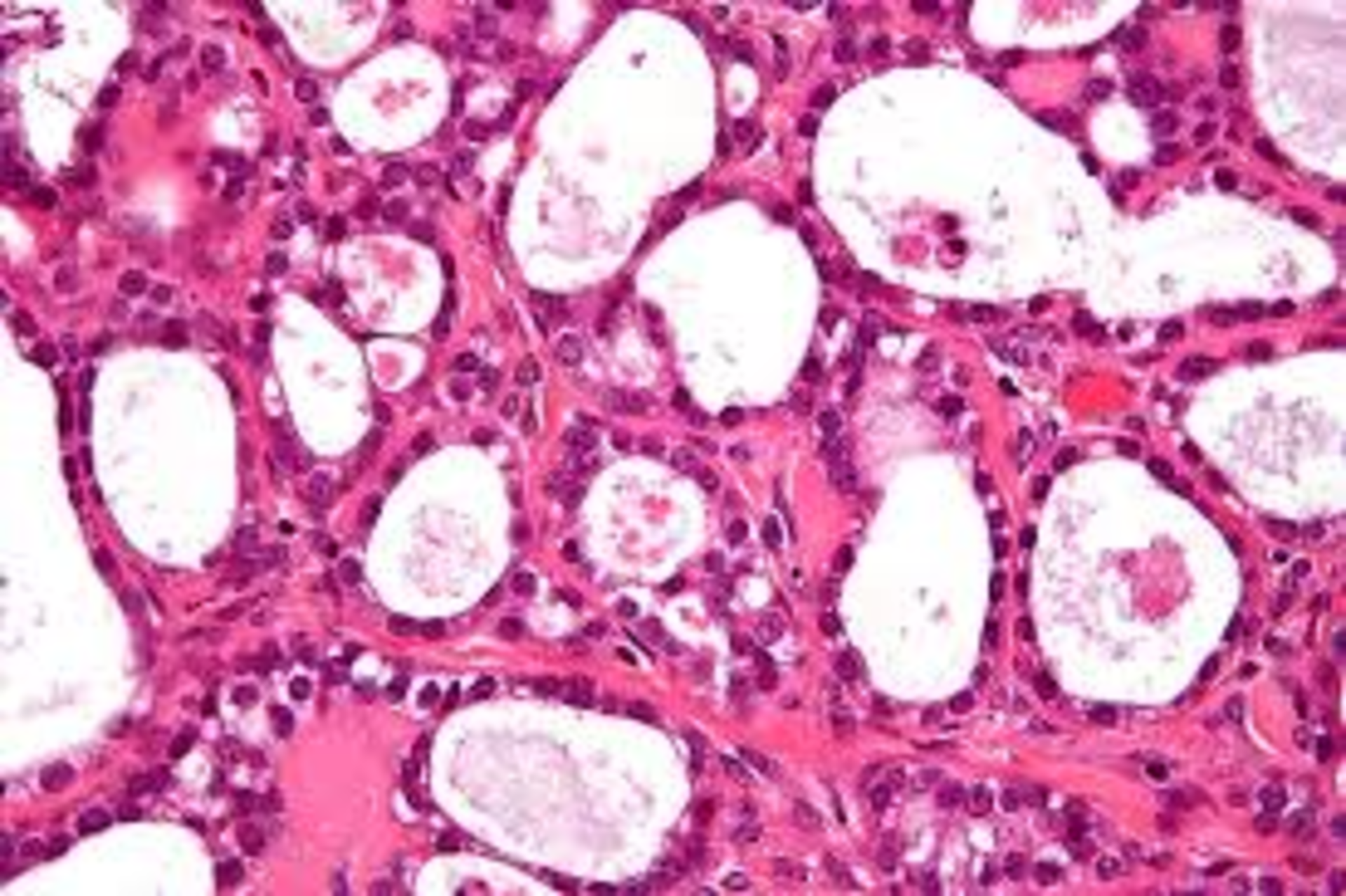 HyperCells will look at Multi Drug Resistance in ovarian cancer cells